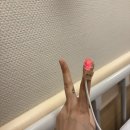 장신경과의원 | 뇌혈관질환 뇌동정맥기형 (AVM) 뇌출혈까지 1️⃣