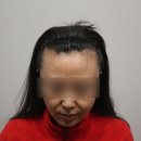 센텀모빅스피부과의원 네이버블로그