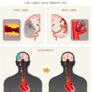 일과성 뇌허혈증(뇌경색, 중풍 조심시기) 이미지