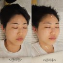 고운:결 | 인천 부평 굴포천역 피부관리 결이고운 고주파관리 후기
