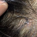 차와사람들 | 이마거상+쌍꺼풀 재재수술 후기_2주차