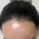 뉴헤어라인 - 순천시 | 부산헤어라인교정 후기, 6개월 경과를 통해 확인하세요