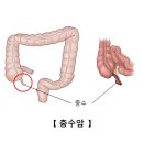 충수암[appendiceal carcinoma]소화기질환, 종양혈액질환 이미지