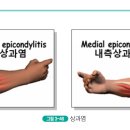 근골격계질환의 종류(상과염) 이미지