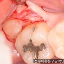 이튼튼구강악안면외과치과의원 네이버블로그