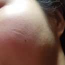 천안 패인흉터 치료 1회차 피부과 레이저 대신 선택한 한의원 새살침 후기