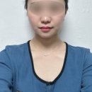 울쎄라·슈링크 말고 요즘 뜨는 리프팅? 린커브 리프팅 신사역 피부과에서 직접 받아본 후기