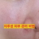 대운한방병원 | <지루성 피부염>나만의 5가지 관리비법 feat.동남아 여행, 여름철