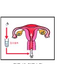 난임의 접근과 해결은 부부가 함께! 이미지