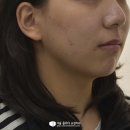 다물어지지 않는 앞니 교정 과정, 상명대 치과
