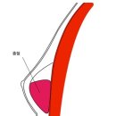 여유증 재수술의 경우... 이미지