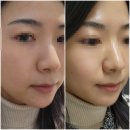 선릉역 피부과 PMC 스킨부스터 물광, 보습 시술 전후 후기