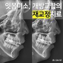 개방교합과 잇몸미소 개선을 위한 재교정 후기