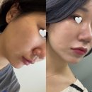 참피부과 | 전주피부과 엠페이스 리프팅 후기 : 중안부 리프팅 통증, 전후 효과 비교