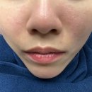 브이 | 붉은 색소치료 - 엑셀브이 레이저후기