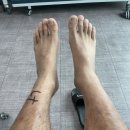 발뒷꿈치 통증 만성 아킬레스건염 하글런드 수술 후기