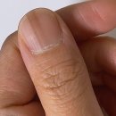 엄지한의원 | 엄지손톱검은세로줄 피부과, 한의원 다녀온 후기