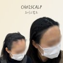 초이스칼프 이미지
