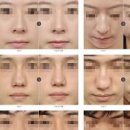 잠잘때 코막힘 비중격만곡증부터 비염까지 약 치료 예방법까지 이미지