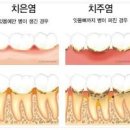 잇몸 부었을 때 잇몸 통증 원인 예방법 이미지