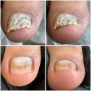 포항시북구33 | 포항 북구 무좀발톱 속시원하게 해결해주는 패디파인 베어플레티넘 포항장량점