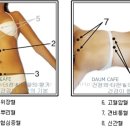 사혈 - 여름 냉한 장 설사에 사혈 하는 법 이미지