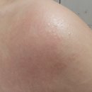 필리핀 보라카이 여행 후 두드러기 햇빛알러지 오일 알레르기 가려움 😢