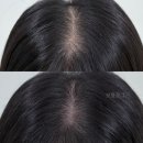 [영등포/당산] 도치도트 탈모 프로그램_ 머리카락이 자라는 모발생장술과 가르마 탈모 해결! 1회차 후기