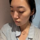 다은메디칼 | 모공 고민으로 멀티플라즈마 일주일 후기, 서울대입구 피부관리 에스테틱다은