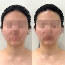 [성남모란 피부관리] &#34;에스테틱 유&#34; 3V 윤곽테라피 후기 | 예신관리 추천
