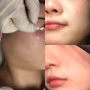 푸른아로마피부샵(운암점) | 푸른아로마피부샵 운암점 문제성 피부 특수관리 썰 3탄