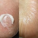 천지당약국 | 약국 발크림 우레아 연고 무좀 스프레이 사용경과