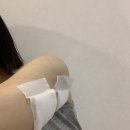 두살차이 | 인천 구월동 피부과 | 바디온다리프팅 + 바디핏주사 팔뚝살 전후차이 후기