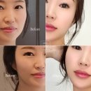 압구정피부과 매직얼굴캣 심부볼 3회차 리얼 후기