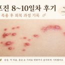 20대 대상포진 후기｜8~10일차 나아가는 중
