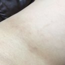 아토피한의원 : 아토파인크림으로 아토피 치료했어요 !