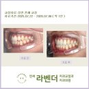 여의도세브란스치과의원 | 여의도 교정 연세라벤더치과 "8월 성인 /직장인 치아교정 후기"