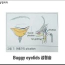 Buggy eyelids 성형술 이미지