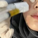 스킨영의원 | 신사역 피부과) 미라젯 줄기세포 피부주사 스킨부스터 시술 + 가격, 통증, 효과, 부작용