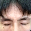 미희네 | 강남피부과 미희주사 눈밑꺼짐 후기 효과