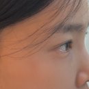 닥터리스의원 | 강동구 천호피부과 코실리프팅 테스코 리얼 후기