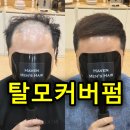 중화가정강동 | 서울 남자 탈모커버펌, 모발이식 없이 정수리·M자 탈모커버 비포에프터 후기