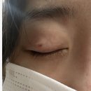 프로비뇨기과의원 | 선릉 힐비뇨기과 잡티제거 서비스 토닝 후기