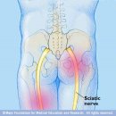 Sciatica 이미지