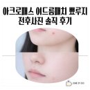 제이큐어 | 아크로패스 트러블큐어 여드름패치 뾰루지 전후사진 솔직 후기