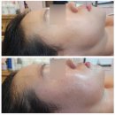 치킨플러스 구미봉곡점 | 구미 봉곡동 피부관리 추천 문스뷰티플러스 봉곡점 얼굴윤곽관리 리얼 후기