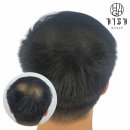 하이스칼프 이미지