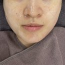 (주)인텐더 | 보톡스 후 관리 후기｜미간·사각턱 크라이오 진정관리 받은 솔직 후기