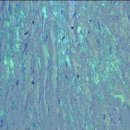 트랜스티레틴 관련 아밀로이드증(Transthyretin-Related Amyloidosis)