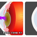 앞이 뿌예지는 백내장… 약물보다 수술이 효과적(백내장 증상과 치료법) 이미지